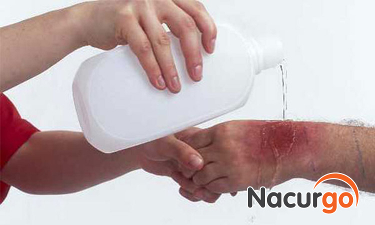 Bị bỏng có thể rửa nước muối sinh lý