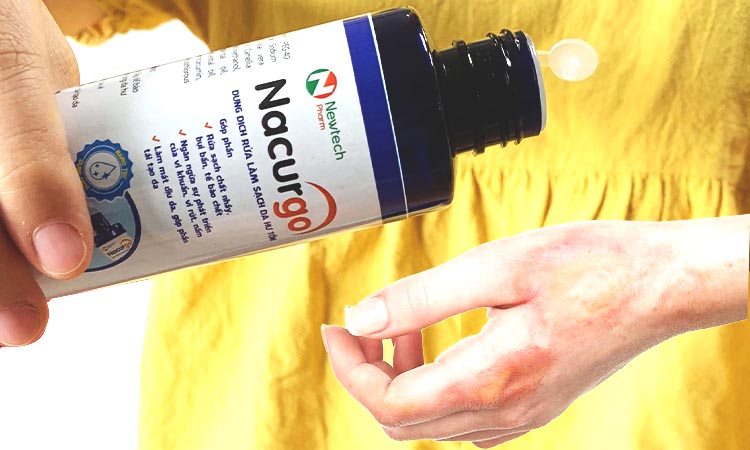 Rửa vết bỏng bằng dung dịch rửa, làm sạch da hư tổn Nacurgo
