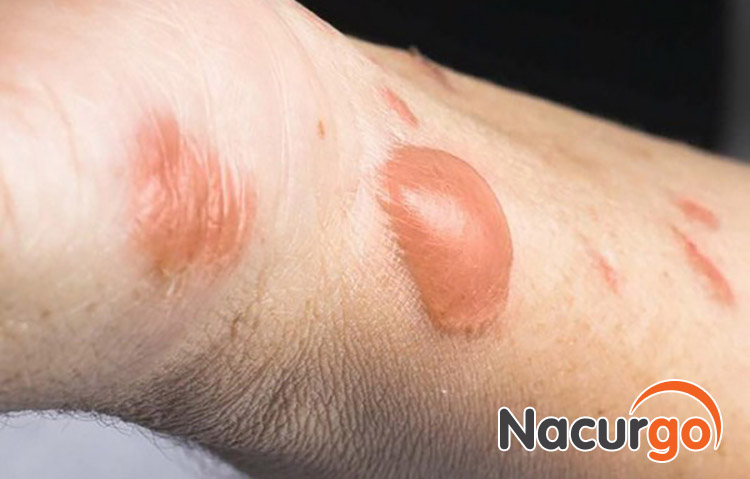 Những vết bỏng có thể để lại sẹo thâm xấu xí nếu không được chăm sóc từ sớm