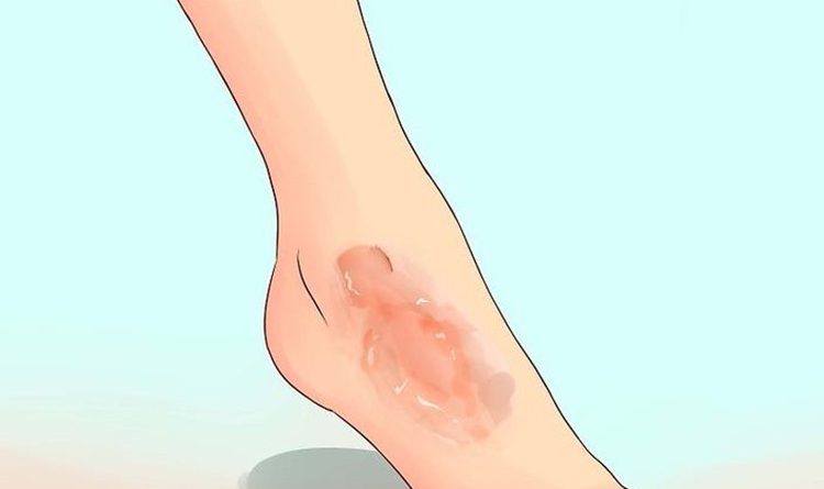Chăm sóc sơ cứu đúng cách ngay từ đầu giúp giảm thiểu nguy cơ gây sẹo
