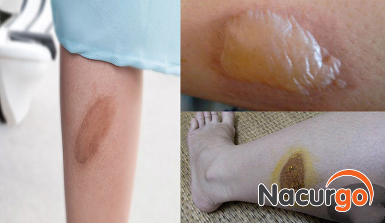Nguy cơ hình thành sẹo hay không phụ thuộc nhiều vào mức độ tổn thương do bỏng