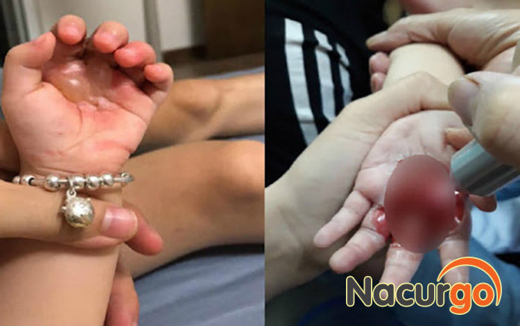 Bỏng nồi cơm điện có thể xảy ra phổ biến ở trẻ nhỏ