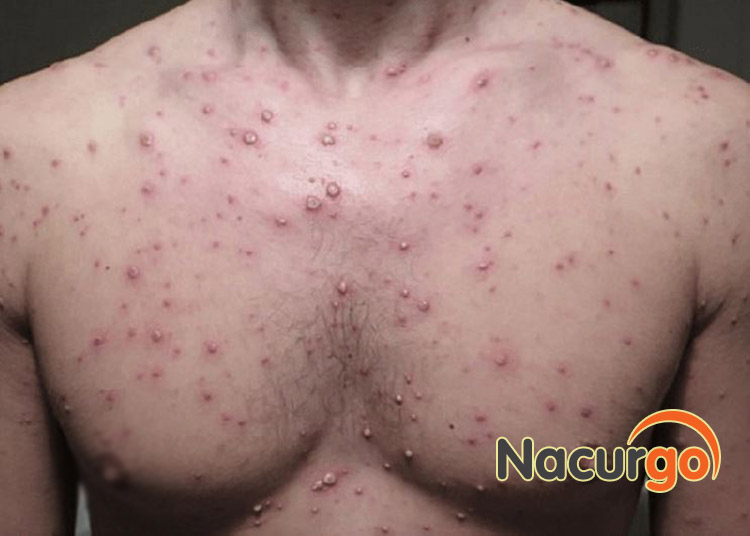 Nốt mụn thủy đậu có nguy cơ bị nhiễm trùng nguy hiểm