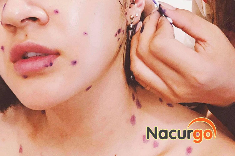 Thủy đậu ảnh hưởng không nhỏ đến cuộc sống và công việc của người bệnh