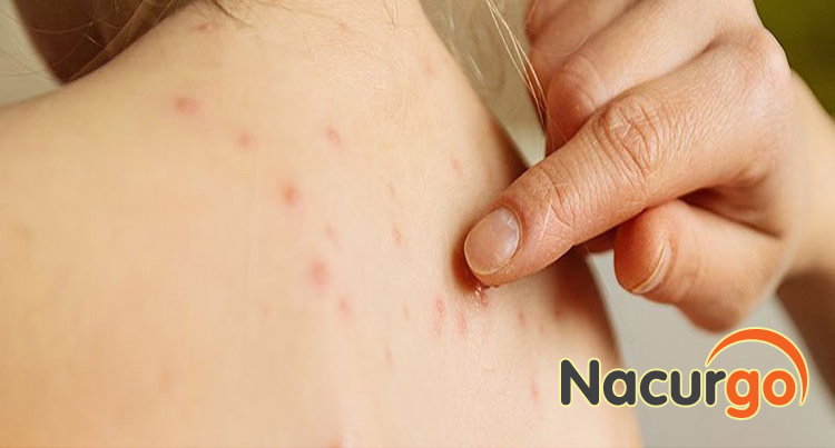 Thủy đậu có thể gây ra sẹo rỗ, sẹo thâm cho người bệnh