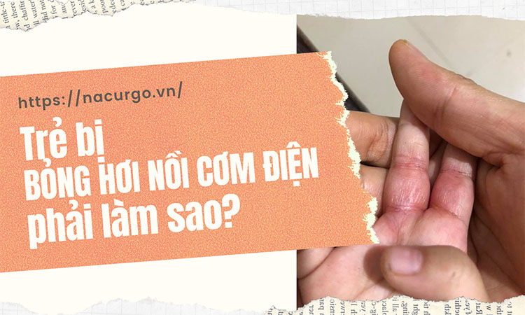 Bị bỏng hơi nồi cơm điện phải làm sao?
