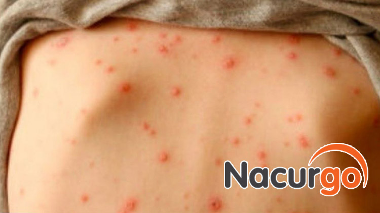 Bỏng dạ gây ra nhiều biến chứng nguy hiểm cho người mắc bệnh