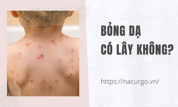 Bỏng dạ có lây hay không?