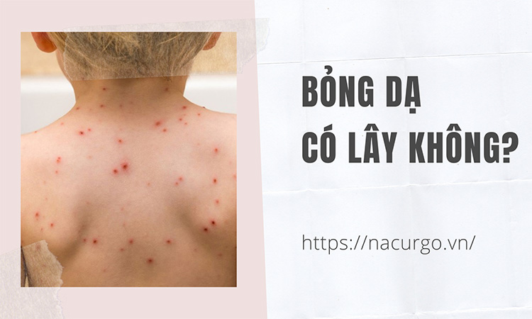 Bỏng dạ có lây hay không?