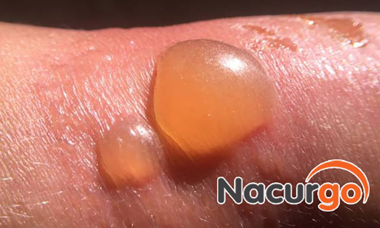 Bỏng dạ có thể tiến triển thành những nốt mụn nước và có nguy cơ vỡ bất kỳ lúc nào