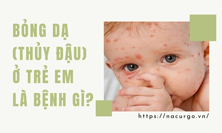 Bỏng dạ (phỏng rạ, thủy đậu) ở trẻ em là bệnh gì