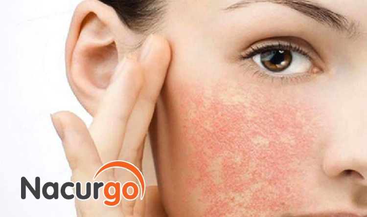 Hình ảnh bỏng da nhẹ trên da mặt