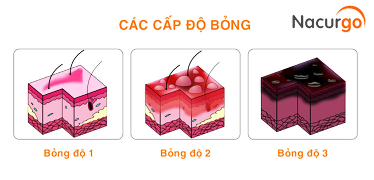 Bỏng có 3 cấp độ cơ bản