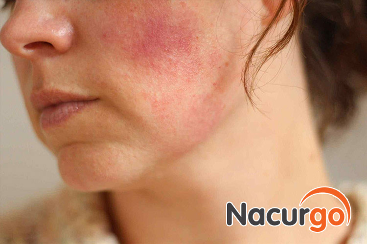 bỏng da nhẹ có thể do kích ứng thành phần trong mỹ phẩm