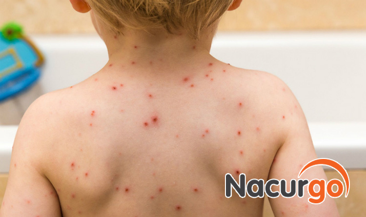 Không gãi làm vỡ các đốm mụn thủy đậu vì nó gia tăng nguy cơ lây lan đến vùng da khác và cho người xung quanh