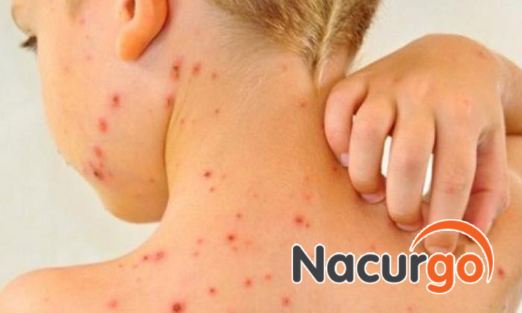 Kiêng gãi vào vết mụn, tránh gây vỡ có nguy cơ gây bội nhiễm