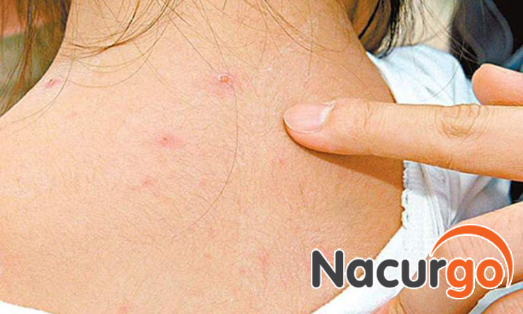 Kiêng không mặc đồ bó sát để vết mụn không bị vỡ do cọ sát với quần áo