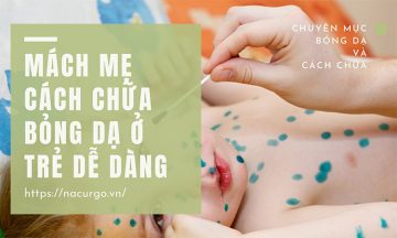 Mách cách trị bỏng dạ thật de dang