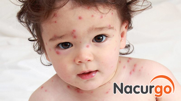 Sẹo lõm là nguy cơ có thể để lại sau khi bỏng dạ hồi phục