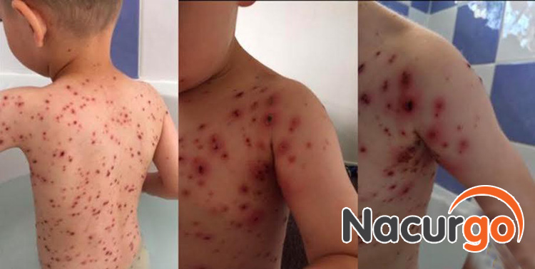 Vệ sinh sạch sẽ vùng bỏng dạ để ngăn ngừa nguy cơ bội nhiễm