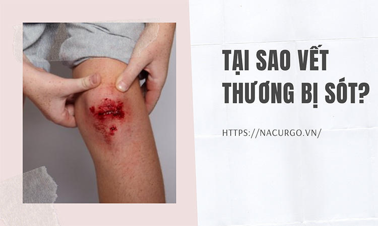 Vết bỏng bị sót