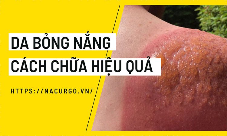 Da bỏng nắng và cách chữa hiệu quả
