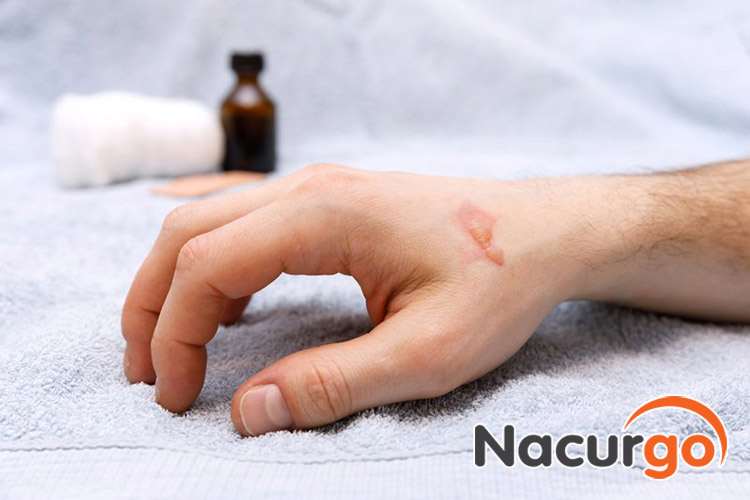 Bỏng mức 2 trở lên có nguy cơ để lại sẹo cho bạn