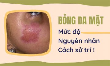Bỏng da mặt và những điều cânf bieets