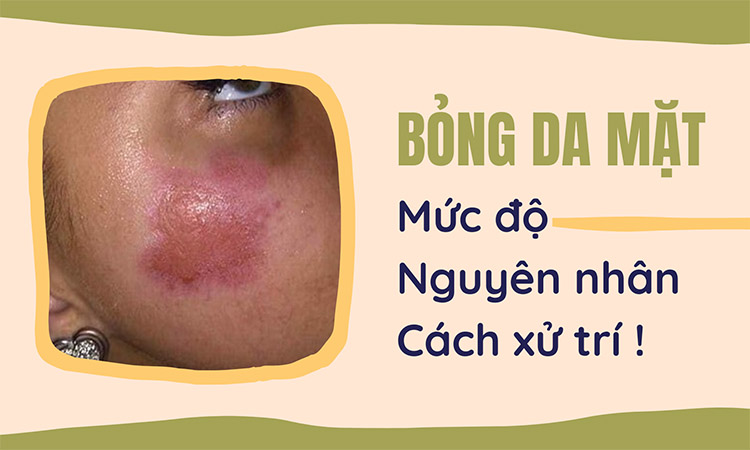Bỏng da mặt và những điều cânf bieets