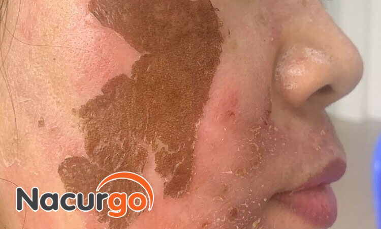Bỏng vùng mặt không chỉ gây đau đớn mà ảnh hưởng không nhỏ đến thẩm mỹ