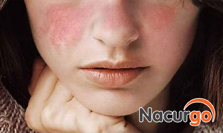 Bỏng dầu ăn trên mặt ảnh hưởng đến thẩm mỹ, công việc và cuộc sống người bệnh