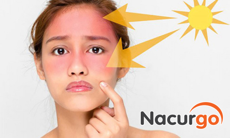 Ánh nắng cũng là một trong những tác nhân gây bỏng cho bạn