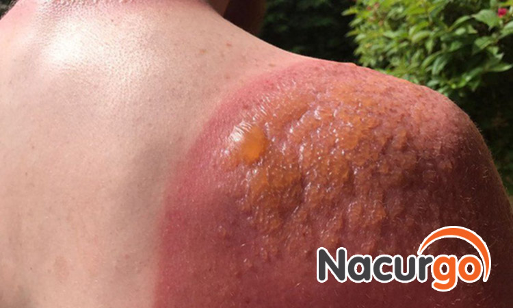 Bỏng nắng mức độ nặng có xuất hiện phồng nước