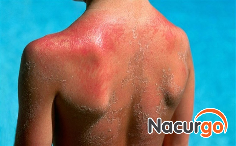 Bỏng nắng mức độ nhẹ