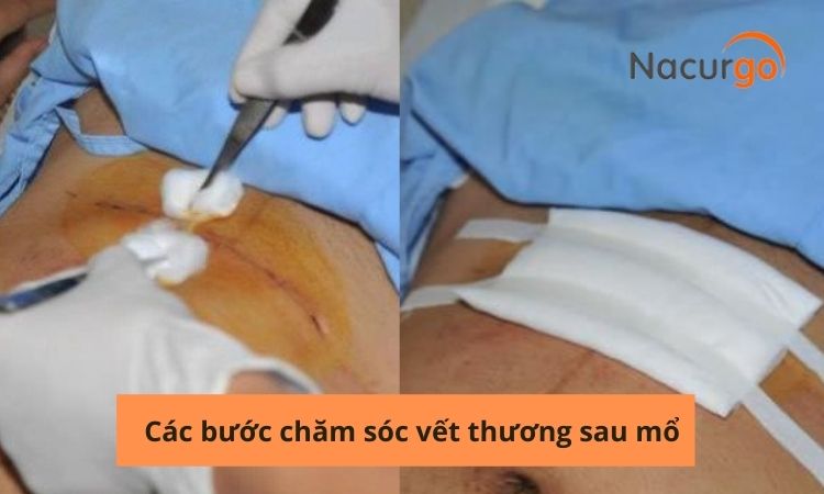 cac-buoc-cham-soc-vet-mo