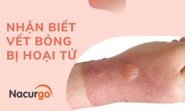 Cách nhận biết vết bỏng bị hoại tử