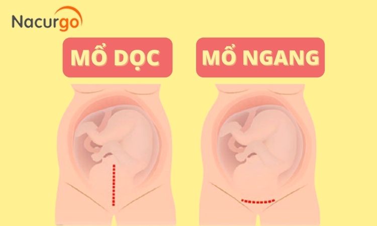 dac-diem-vet-mo-de