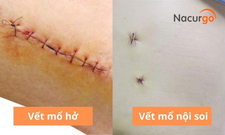 dac-diem-vet-thuong-sau-mo