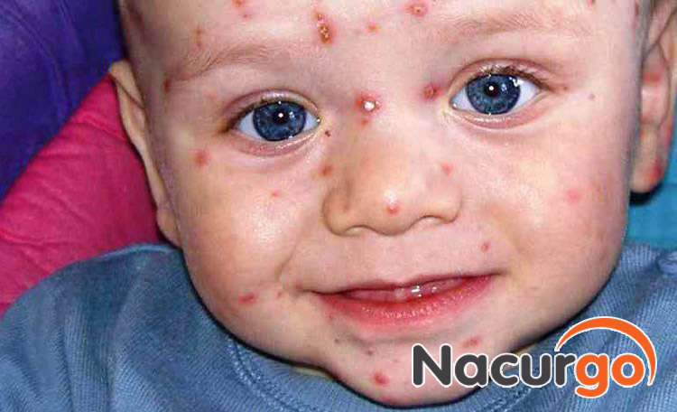 Dấu hiệu bỏng dạ không chỉ là những đốm mụn nước đỏ trên cơ thể bé