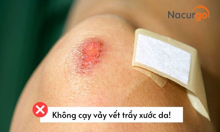 khong-cay-vay-vet-tray-da
