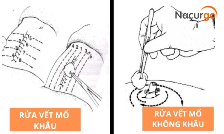 ki-thuat-rua-vet-thuong