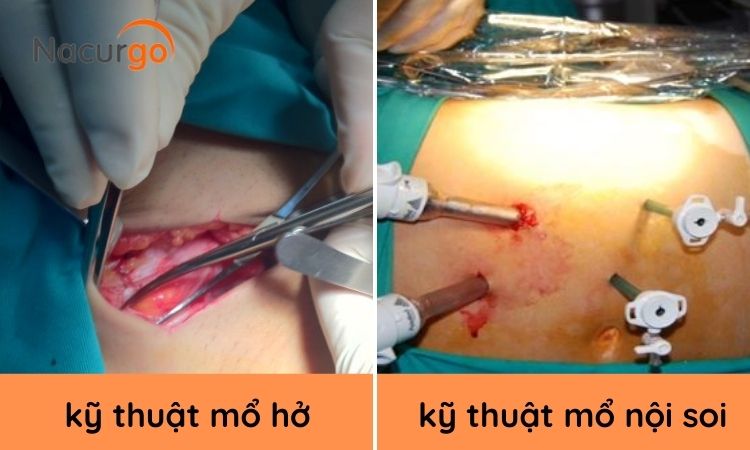 ky-thuat-mo-lay-than