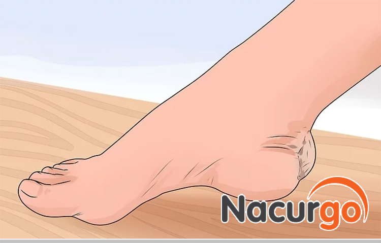 Bỏng cấp 2 có dấu hiệu phồng nước cũng có nguy cơ gây sẹo