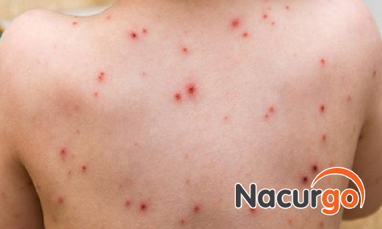 Bỏng dạ có nguy cơ để sẹo lõm mất thẩm mỹ