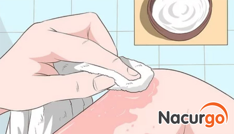 Có thể sử dụng sữa chua để đắp lên da bỏng nắng