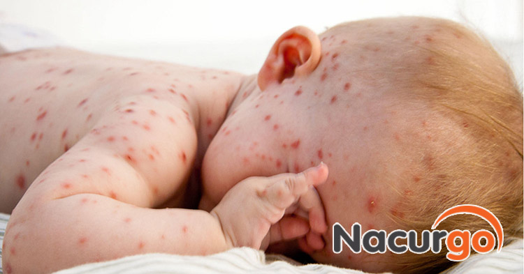 Ngoài vấn đề thẩm mỹ, trẻ còn có thể bị biến chứng đến phổi, não...