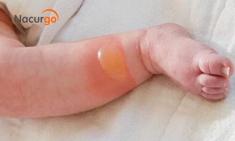 vet-thuong-noi-bong-nuoc