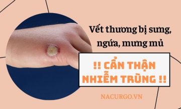 vet-thuong-sung-ngua-mung-mu