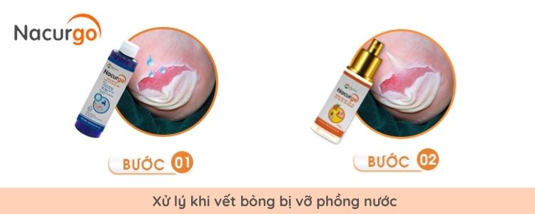 xu-ly-vet-bong-bi-vo