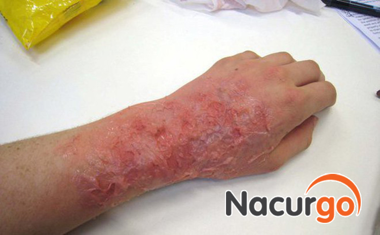 Nhiễm trùng vết bỏng là nguy cơ gây ra sẹo thâm